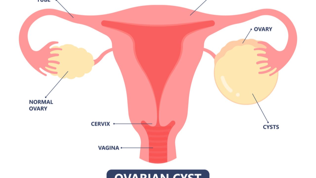 Cisto No Ovário Causas Sintomas E Tratamento 41 OFF