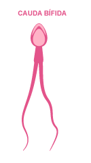 espermatozoide com cauda bífida