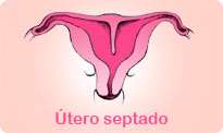 utero-septado-e-a-fertilidade-feminina
