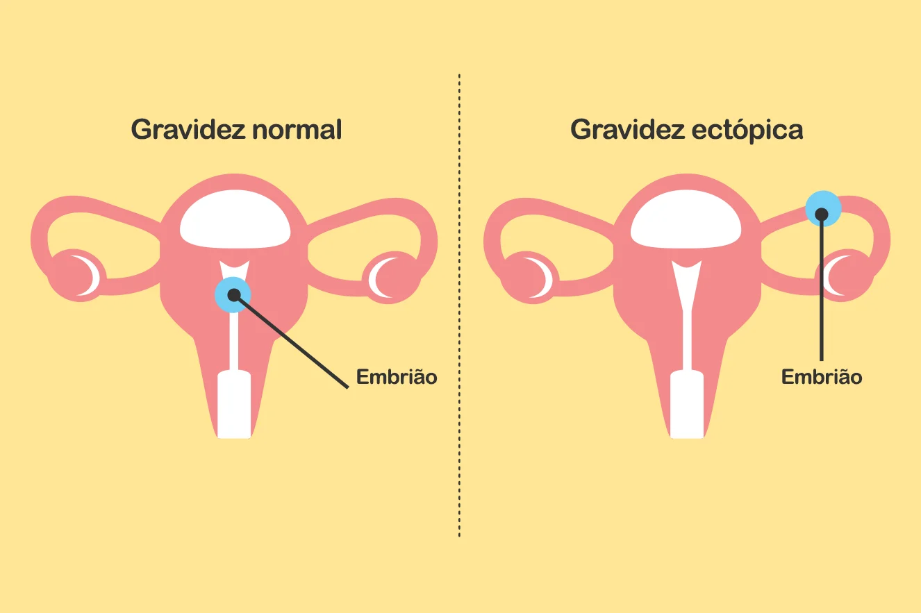 Sinais de gravidez ectópica