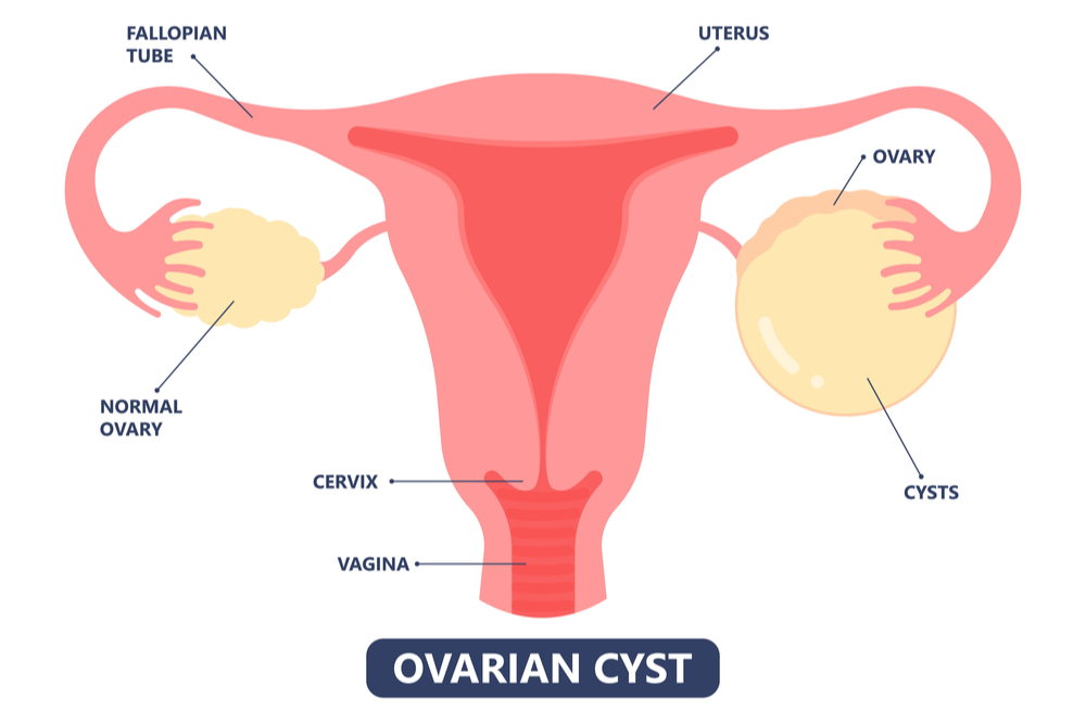 Cistos no ovário: uma grande dúvida das mulheres