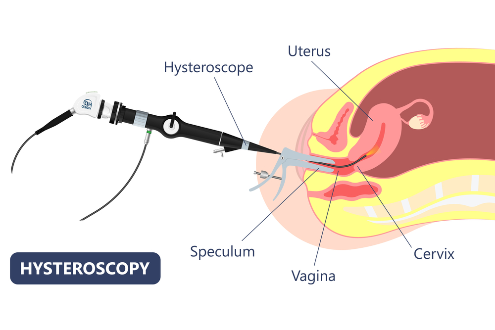 Histeroscopia: entenda como é feita!