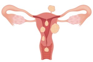 Miomatose uterina: o que é e relação com a infertilidade