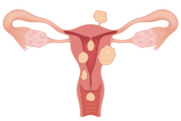 Desenho de miomatose uterina