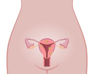 3 Tipos de Miomas Uterinos