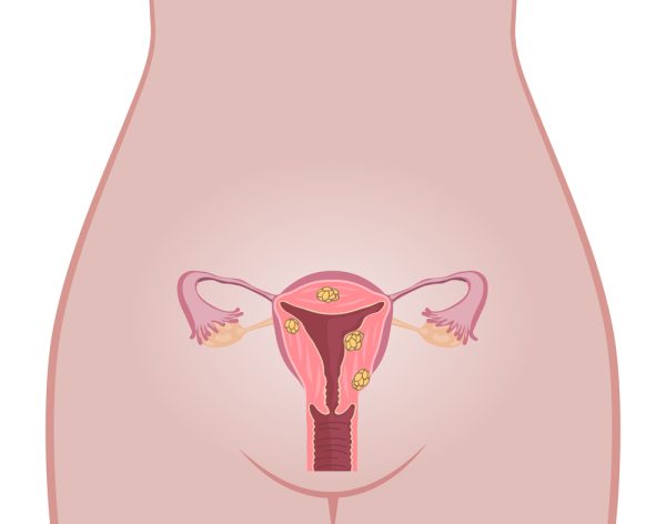 Desenho de miomas uterinos