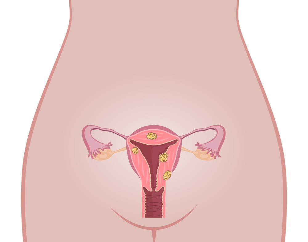 3 Tipos de Miomas Uterinos