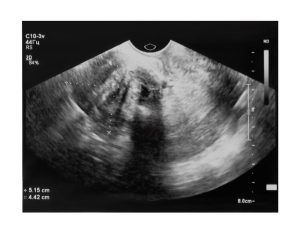 Como é feito o diagnóstico de mioma uterino?