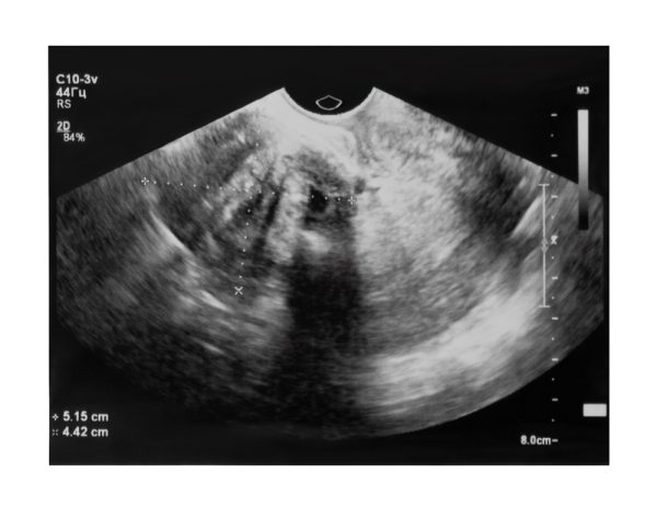 Ultrassom de mioma uterino