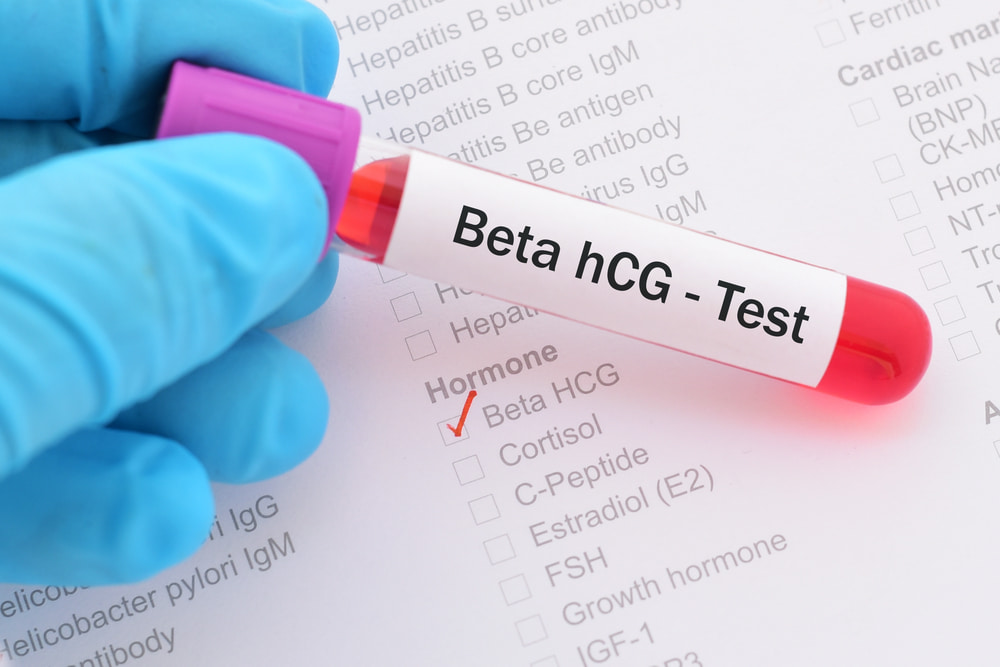 Resultados de beta quantitativo em laboratórios diferentes. Me ajudem por  favor