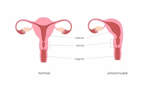 Útero unicorno: o que é e como afeta a fertilidade?