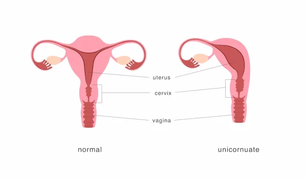 imagem ilustrativa sobre o útero unicorno