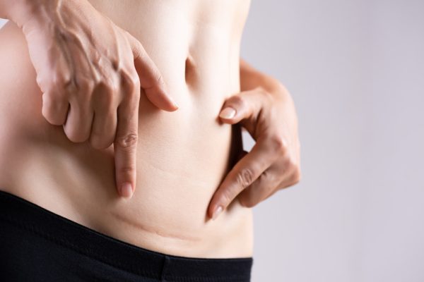 Barriga de mulher com cicatriz de cesárea.