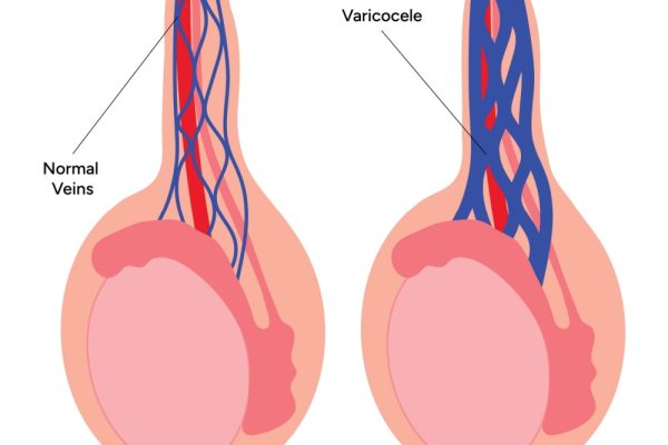Imagem ilustrando localização da varicocele