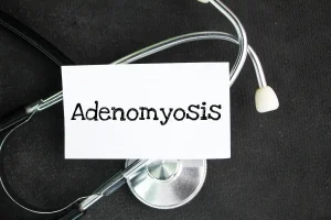 Adenomiose focal: sintomas, causas e tratamento