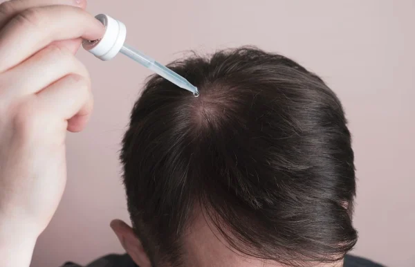 Homem aplicando minoxidil na cabeça careca representando questionamento sobre infertilidade masculina.