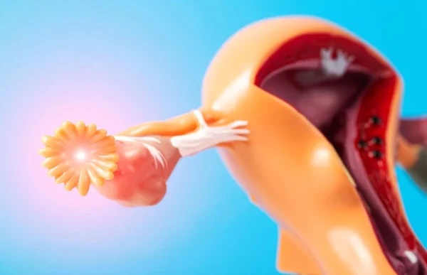 Ilustração mostrando útero, ovários e trompas inflamadas para representar a salpingite.