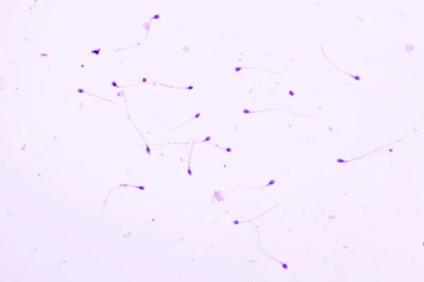Espermatozoides vistos ao microscópio representando alterações morfológicas.