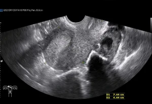 O que são as malformações uterinas?