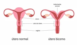 Útero bicorno e infertilidade: sintomas, diagnóstico e tratamentos