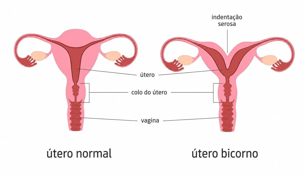 Útero bicorno e infertilidade: sintomas, diagnóstico e tratamentos