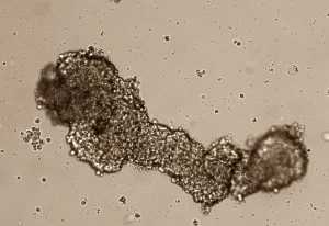 FIV e câncer: hormônios da fertilização in vitro podem causar câncer?