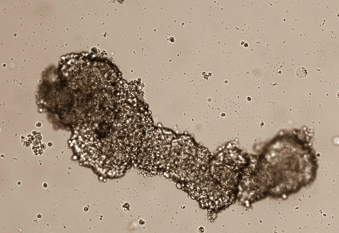 FIV e câncer: hormônios da fertilização in vitro podem causar câncer?